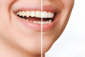An Expert Insight into Teeth Cleaning Before and After An Expert Insight into Teeth Cleaning Before and After