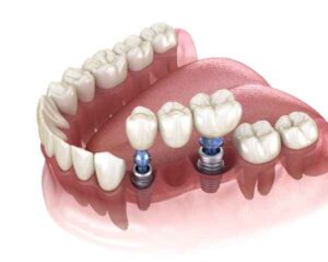 dental implants Liverpool