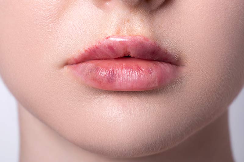 lip fillers in islamabad