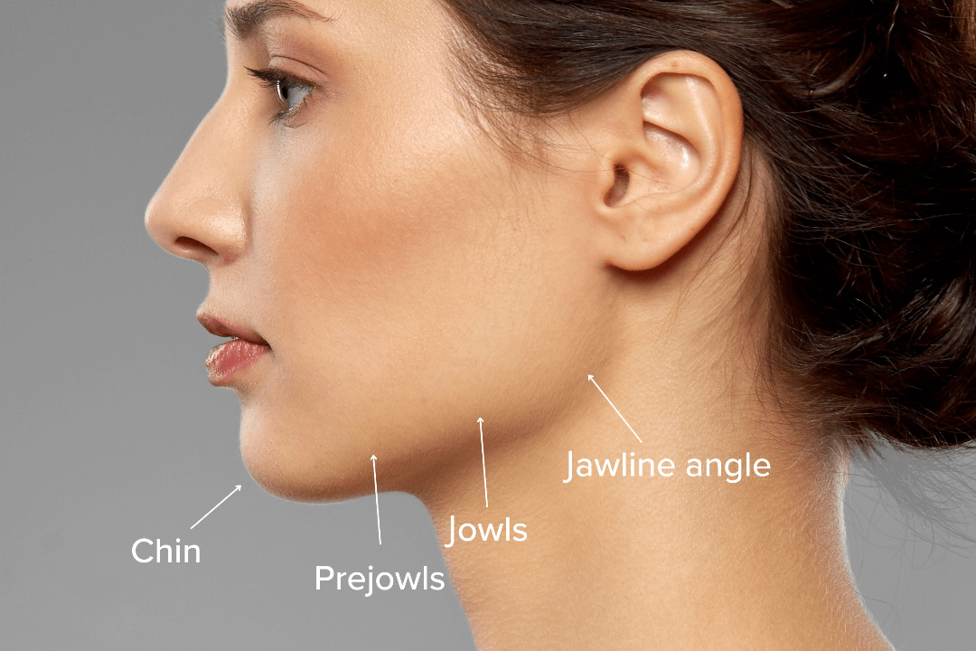 jawline filler injections