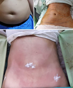 laser fat removal in pakistan