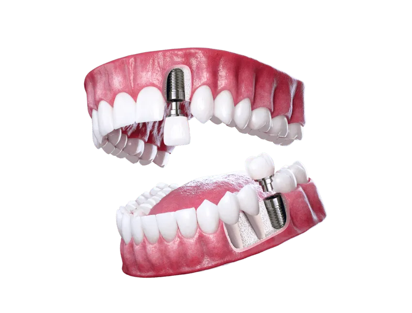 implant dentistry Aberdeen