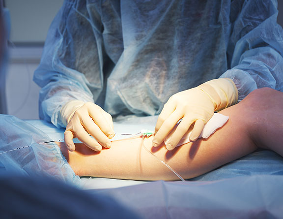 how much does varicose vein treatment cost