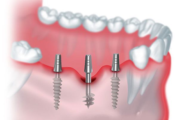 best dental implant Aberdeen